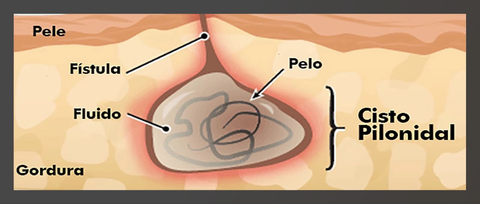 Diagrama de cisto pilonidal