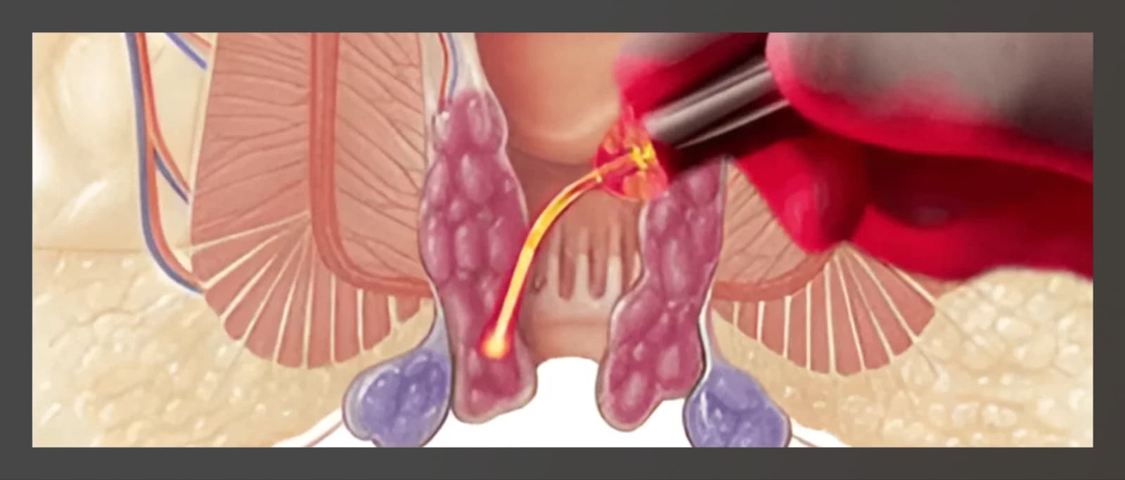 Ilustração do tratamento de hemorroidas a laser